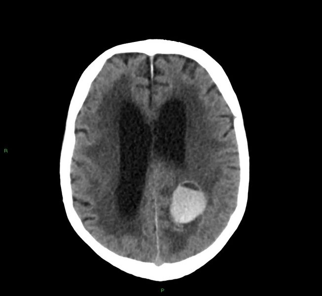 File:Cerebral amyloid angiopathy-associated lobar intracerebral hemorrhage (Radiopaedia 58530-65688 Axial non-contrast 18).jpg