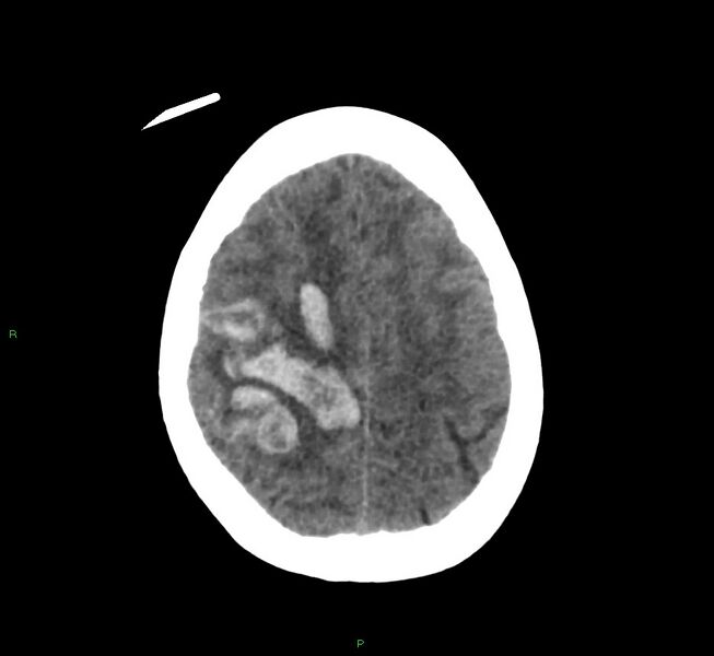 File:Cerebral amyloid angiopathy-associated lobar intracerebral hemorrhage (Radiopaedia 58566-65730 Axial non-contrast 13).jpg