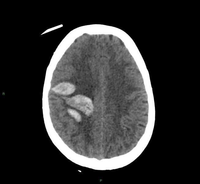 File:Cerebral amyloid angiopathy-associated lobar intracerebral hemorrhage (Radiopaedia 58566-65730 Axial non-contrast 17).jpg