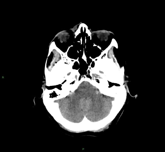 File:Cerebral amyloid angiopathy-associated lobar intracerebral hemorrhage (Radiopaedia 58751-65972 Axial non-contrast 40).jpg
