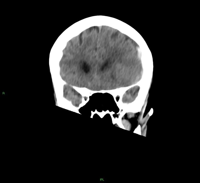 Cerebral amyloid angiopathy-associated lobar intracerebral hemorrhage (Radiopaedia 58754-65975 Coronal non-contrast 43).jpg