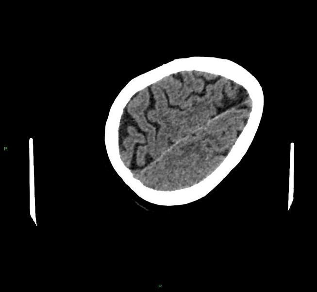 File:Cerebral amyloid angiopathy-associated lobar intracerebral hemorrhage (Radiopaedia 58757-65979 Axial non-contrast 118).jpg