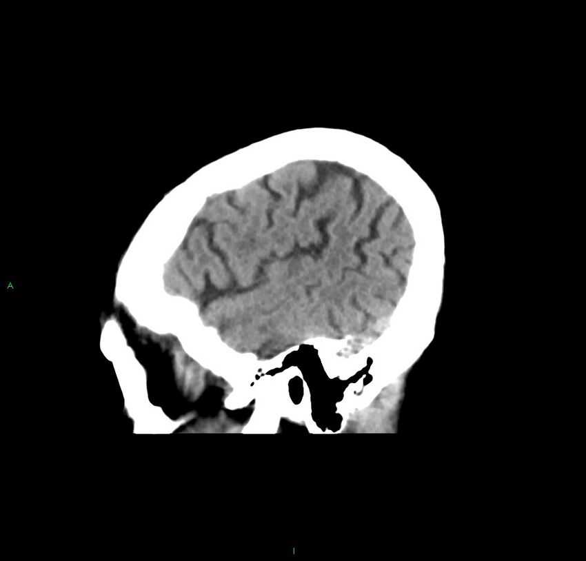 Cerebral amyloid angiopathy-associated lobar intracerebral hemorrhage (Radiopaedia 59356-66716 C 45).jpg