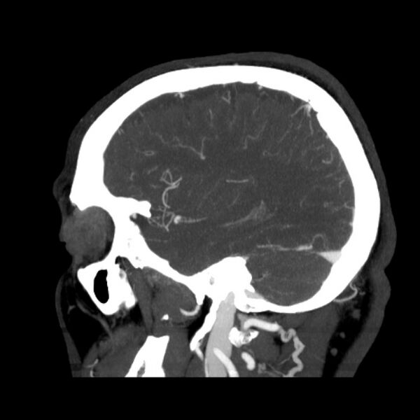 File:Cerebral arteriovenous malformation (Radiopaedia 43729-47189 D 12).jpg