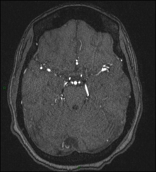 File:Cerebral fat embolism (Radiopaedia 35022-36525 Axial TOF 74).jpg