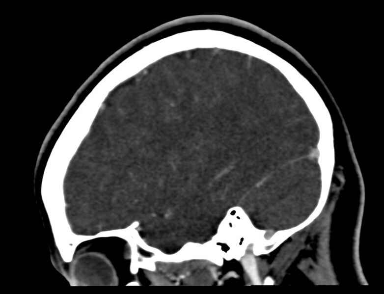 File:Cerebral venous sinus thrombosis (Radiopaedia 59224-66646 Sagittal C+ delayed 1).jpg