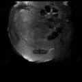 Cervical carcinoma (Radiopaedia 78847-91705 Coronal T2 fat sat 2).jpg