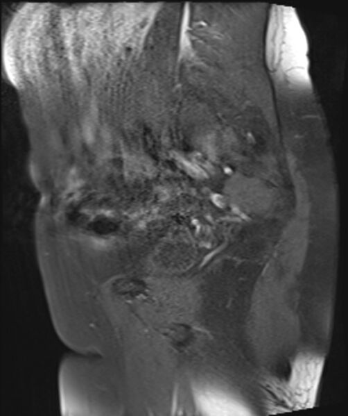 File:Cervical carcinoma (Radiopaedia 88312-104943 Sagittal T1 fat sat 10).jpg
