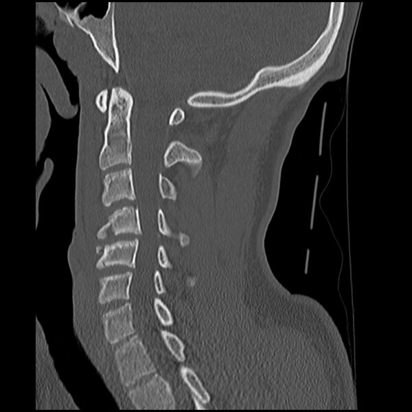 File:Cervical flexion teardrop fracture with cord hemorrhage (Radiopaedia 32497-33454 Sagittal bone window 20).jpg
