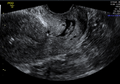 Cervical polyp (Radiopaedia 36734).png