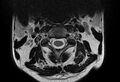 Cervical schwannoma (Radiopaedia 72399-82934 Axial T2 2).jpg