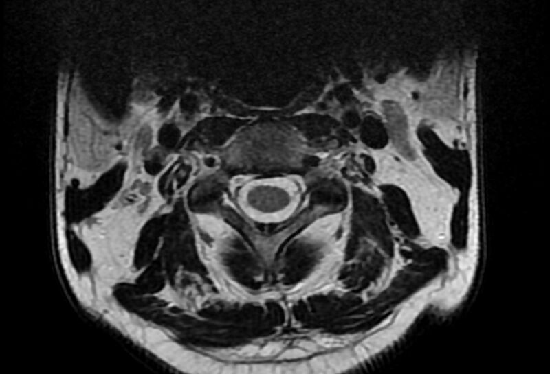 File:Cervical schwannoma (Radiopaedia 72399-82934 Axial T2 2).jpg