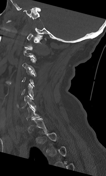 File:Cervical spine fracture - chalk stick (Radiopaedia 39116-41323 Sagittal bone window 19).png