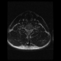 Cervical vertebrae metastasis (Radiopaedia 78814-91667 Axial T2 5).png