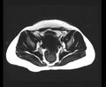 Cesarean section scar endometrioma (Radiopaedia 56569-63297 Axial T1 2).jpg