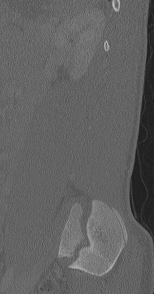 File:Chance fracture (Radiopaedia 40360-42912 Sagittal bone window 21).png