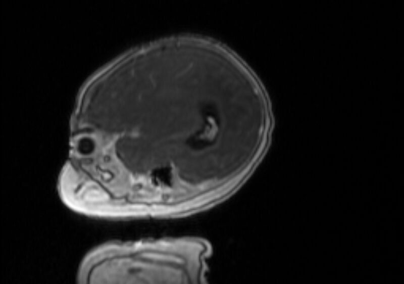 File:Chiari III malformation with occipital encephalocele (Radiopaedia 79446-92559 Sagittal T1 C+ mpr 51).jpg