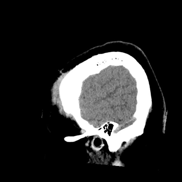 File:Chiasmatic-hypothalamic juvenile pilocytic astrocytoma (Radiopaedia 78533-91237 B 12).jpg