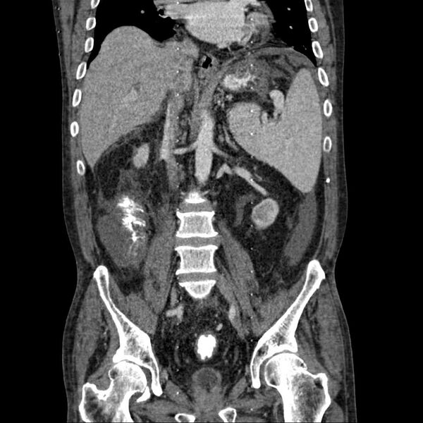 File:Cholangitis and abscess formation in a patient with cholangiocarcinoma (Radiopaedia 21194-21100 C 12).jpg