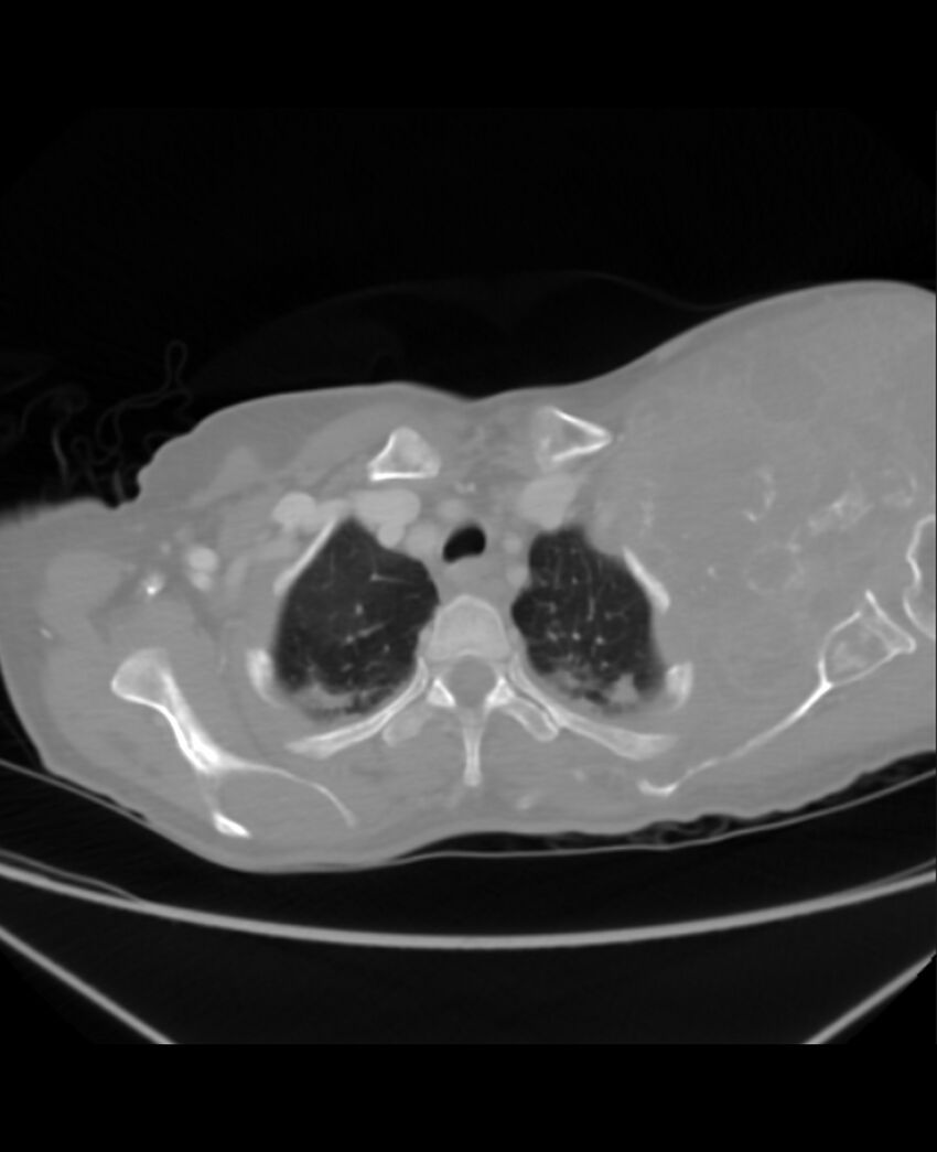 Chondrosarcoma (Radiopaedia 79427-92535 Axial lung window 8).jpg