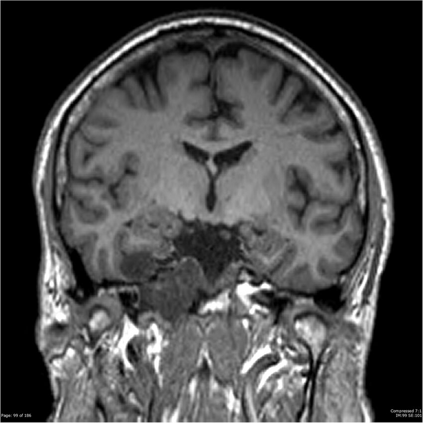 Chondrosarcoma of skull base- grade II (Radiopaedia 40948-43654 Coronal T1 20).jpg