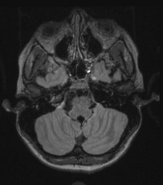 File:Choroid plexus carcinoma (Radiopaedia 91013-108553 Axial FLAIR C+ 89).jpg