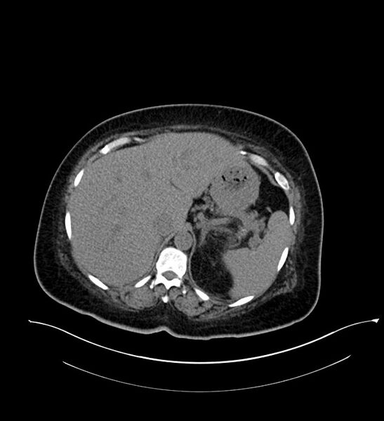 File:Chromophobe renal cell carcinoma (Radiopaedia 84239-99519 Axial non-contrast 44).jpg
