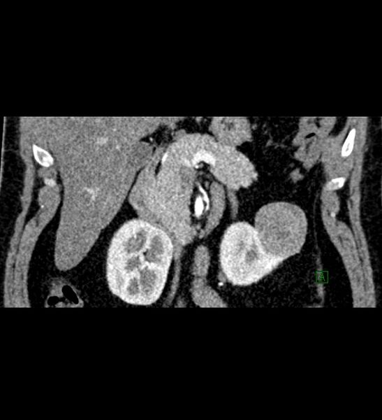 File:Chromophobe renal cell carcinoma (Radiopaedia 84286-99573 E 22).jpg