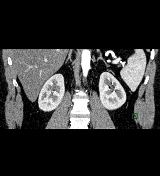 File:Chromophobe renal cell carcinoma (Radiopaedia 84286-99573 E 56).jpg