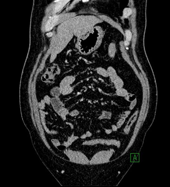 File:Chromophobe renal cell carcinoma (Radiopaedia 84286-99573 H 41).jpg