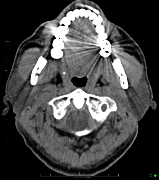 File:Chronic Submandibular sialolithiasis (Radiopaedia 16880-16606 Axial non-contrast 6).jpg