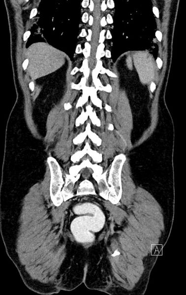 File:Chronic appendicitis complicated by appendicular abscess, pylephlebitis and liver abscess (Radiopaedia 54483-60700 C 67).jpg