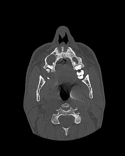 File:Chronic maxillary sinusitis caused by a foreign body (Radiopaedia 58521-65676 Axial bone window 48).jpg