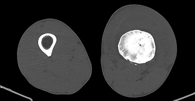 File:Chronic osteomyelitis (with sequestrum) (Radiopaedia 74813-85822 Axial non-contrast 126).jpg