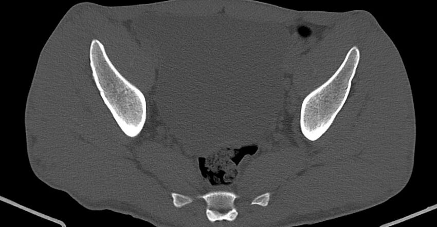 Chronic osteomyelitis (with sequestrum) (Radiopaedia 74813-85822 Axial non-contrast 22).jpg