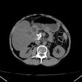 Chronic pancreatitis (Radiopaedia 23132-23172 Axial non-contrast 33).jpg