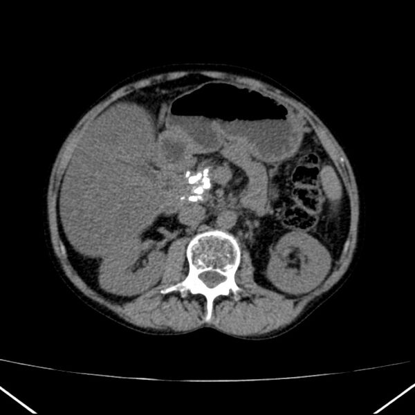File:Chronic pancreatitis (Radiopaedia 23132-23172 Axial non-contrast 33).jpg