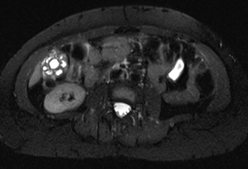 Chronic pancreatitis - pancreatic duct calculi (Radiopaedia 71818-82250 Axial T2 fat sat 43).jpg
