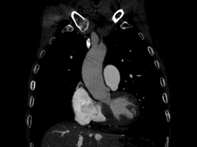 File:Chronic pulmonary embolism (Radiopaedia 91241-108843 A 30).jpg