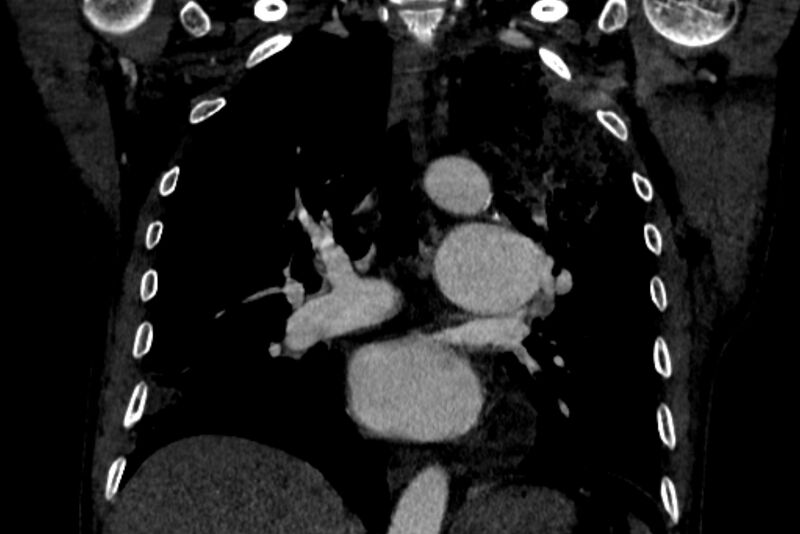 File:Chronic pulmonary embolism with bubbly consolidation (Radiopaedia 91248-108850 B 79).jpg