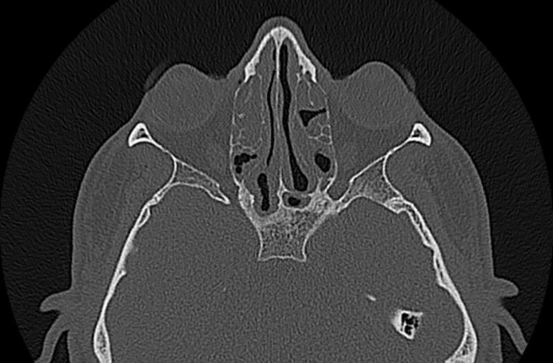 File:Chronic rhinosinusitis (Radiopaedia 65079-74075 Axial bone window 49).jpg