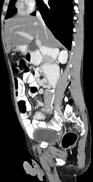 File:Chronic small bowel volvulus (Radiopaedia 75224-86322 C 90).jpg