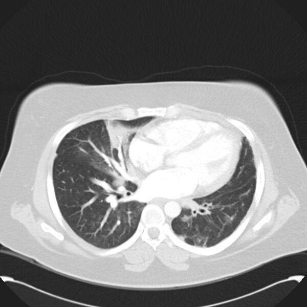File:Chronic thromboembolic pulmonary hypertension (CTEPH) (Radiopaedia 74597-85531 Axial lung window 30).jpg