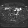 Class II Mullerian duct anomaly- unicornuate uterus with rudimentary horn and non-communicating cavity (Radiopaedia 39441-41755 Axial T2 fat sat 8).jpg