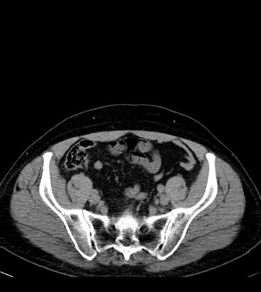File:Clear cell renal cell carcinoma (Radiopaedia 85006-100539 Axial non-contrast 69).jpg