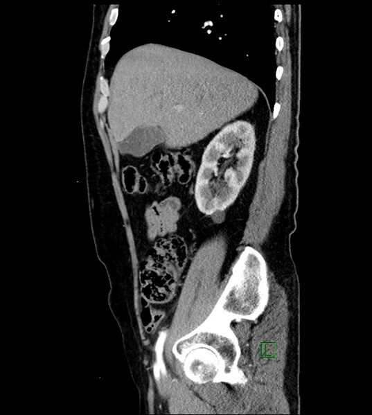 File:Clear cell renal cell carcinoma (Radiopaedia 85006-100539 E 44).jpg