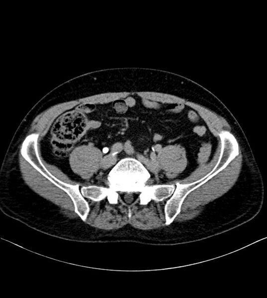 File:Clear cell renal cell carcinoma (Radiopaedia 85006-100539 H 42).jpg