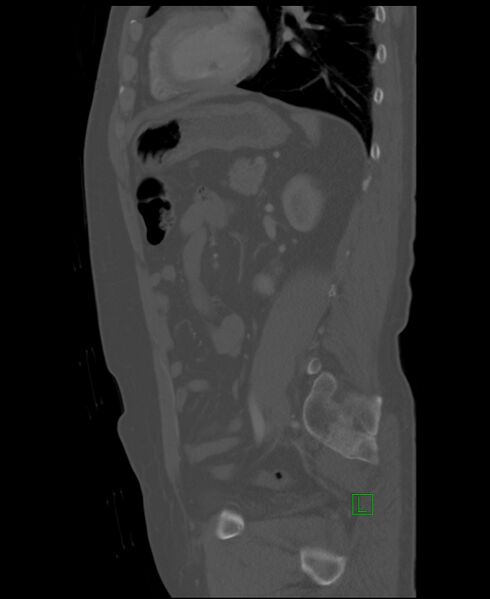 File:Clear cell renal cell carcinoma (Radiopaedia 85006-100539 Sagittal bone window 21).jpg