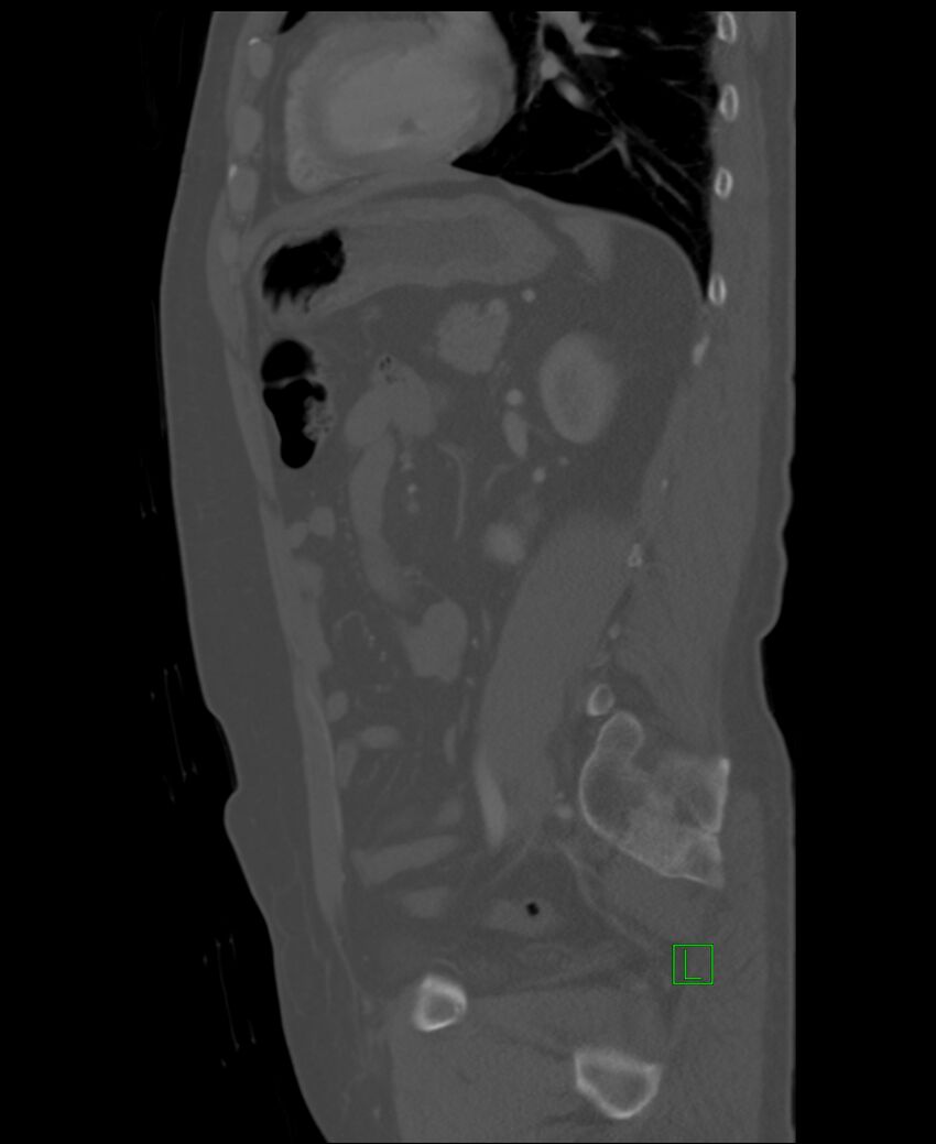 Clear cell renal cell carcinoma (Radiopaedia 85006-100539 Sagittal bone window 21).jpg