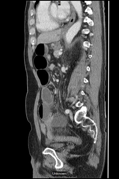 File:Closed loop bowel obstruction and ischemia (Radiopaedia 86959-103180 C 25).jpg